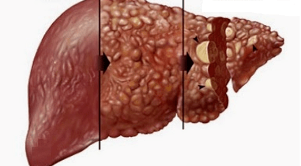 efectos nocivos del alcohol en el hígado humano