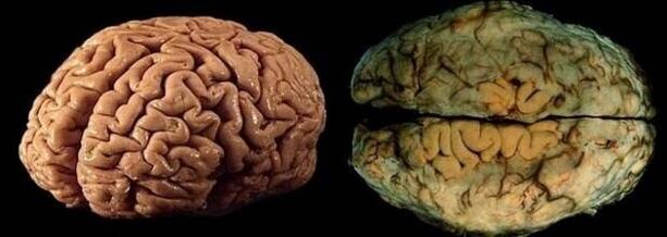 el cerebro de una persona sana y bebedor